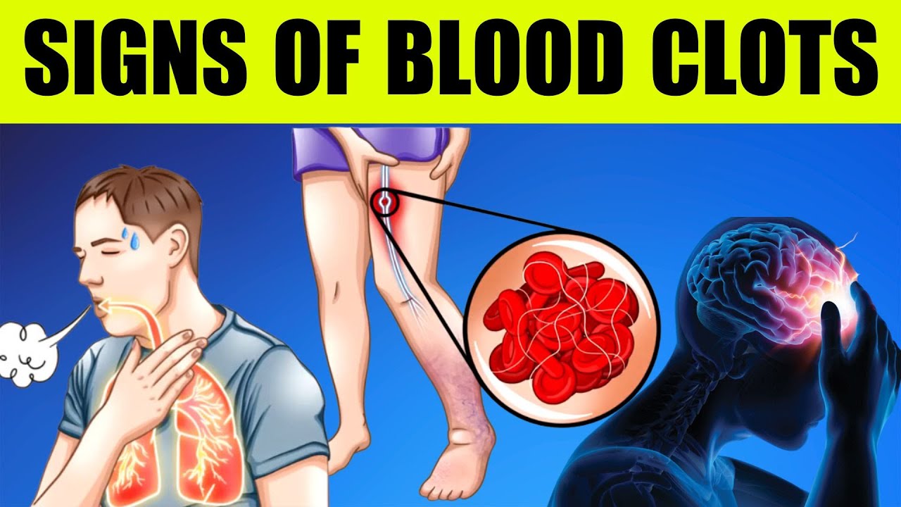 TOP 9 Warning SIGNS of BLOOD CLOTS
