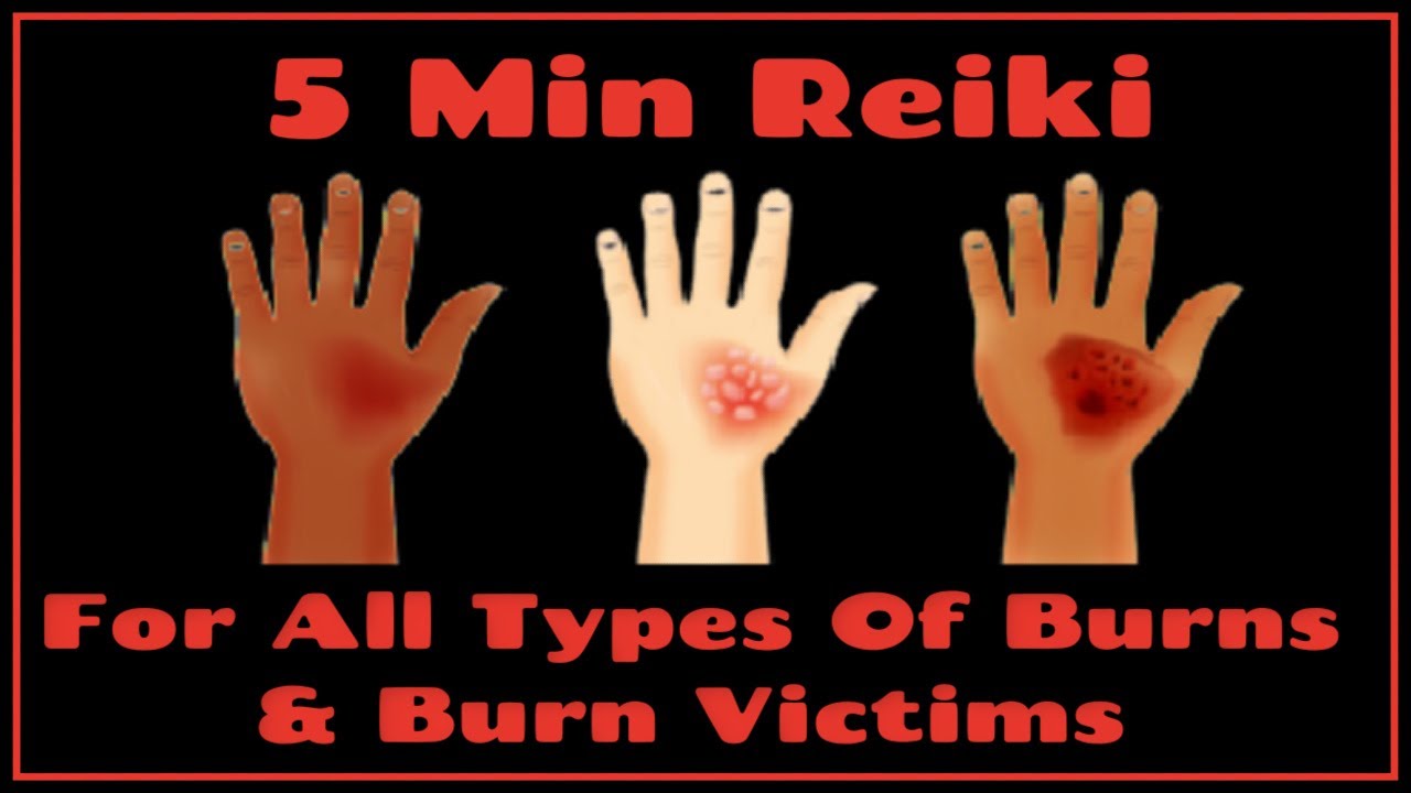 Reiki For All Types Of Burns & Burn Victims  - 5 Minute Session - Healing Hands Series