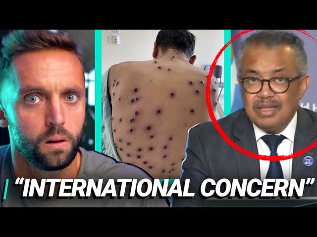 Monkey Pox: New Global Pandemic? | Kap Reacts