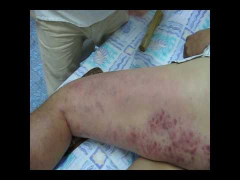 Bamboo Magic-Pseudosciatica ("偽"坐骨神經痛 )