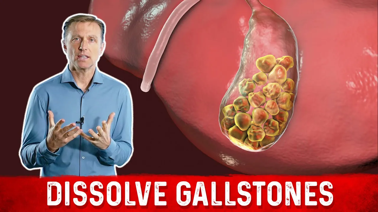 What Causes Gallstones & How to Treat Them – Dr.Berg