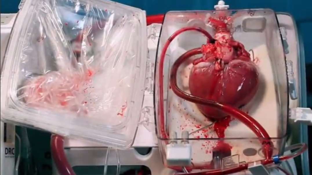 Myocarditis and Pericarditis After mRNA COVID-19 Vaccination
