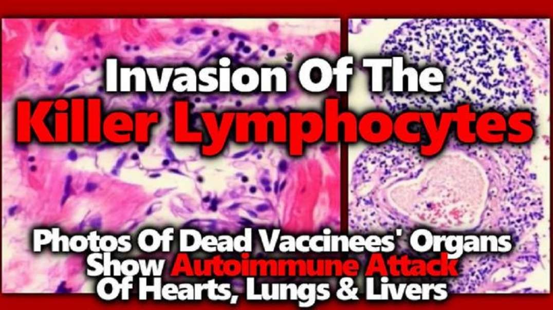 Drs Sucharit Bhakdi & Michael Palmer: Vaccinee Autopsies – Killer Lymphocytes Invade Vital Organs