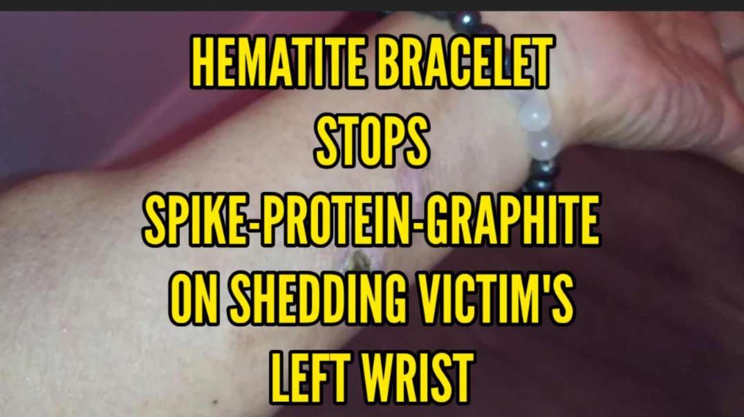 HEMATITE BRACELET STOPS SPIKE-PROTEIN-GRAPHITE ON SHEDDING VICTIM'S LEFT WRIST