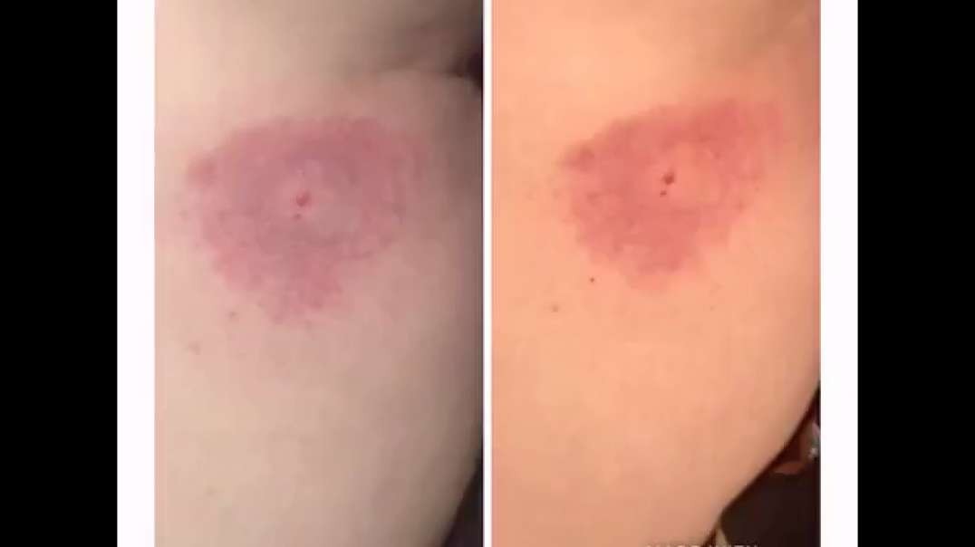 MORE RADIATION BURN VICTIMS FROM MICROWAVE WEAPON USED ON CANBERRA FREEDOM CONVOY
