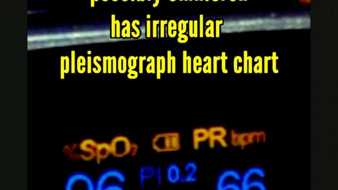 Person with flu symptoms possibly Omnicron has irregular  pleismograph heart chart