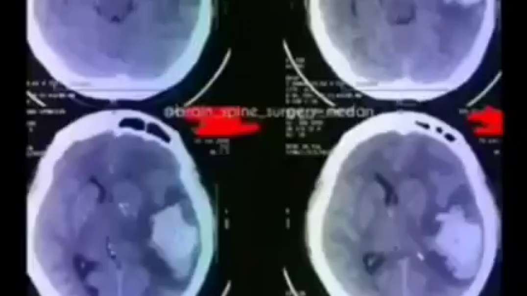 covid vaccine causes massive brain clot (mirrored)
