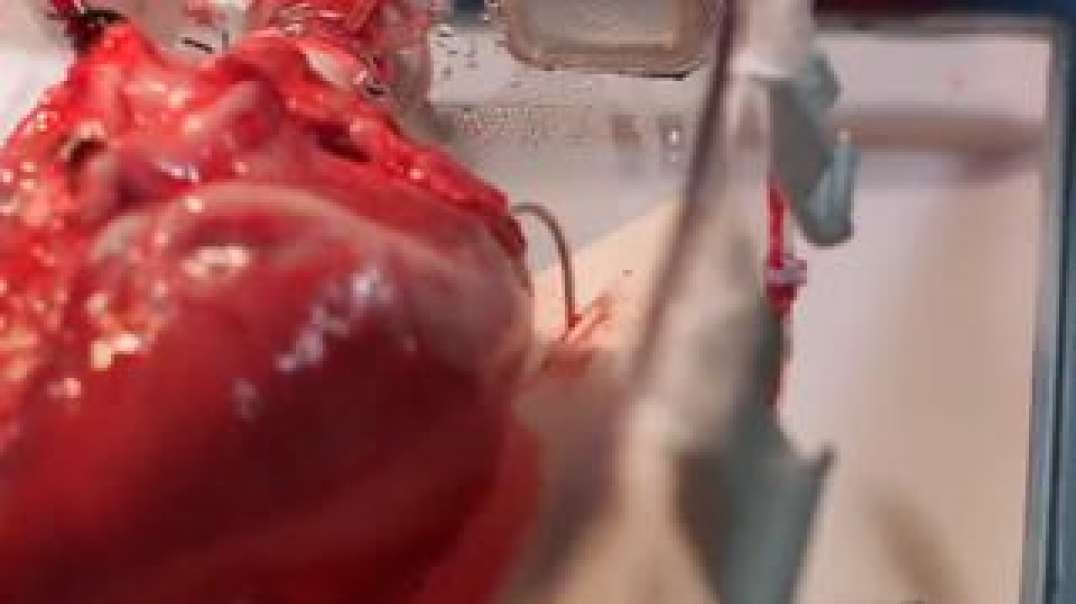 Myocarditis and Pericarditis After mRNA COVID-19 Vaccinationn
