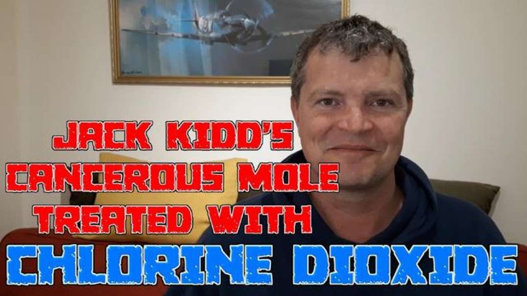 JACK KIDDS CANCEROUS MOLE TREATED WITH CHLORINE DIOXIDE (MMS) INCREDIBLE