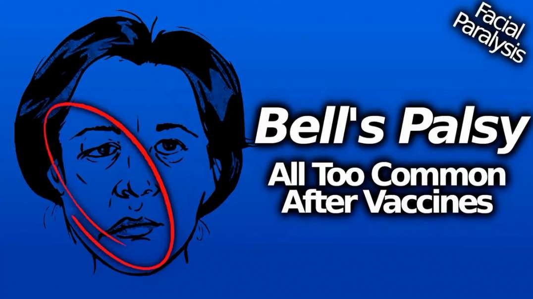 1yr ago 2,500+ VAERS Reports Of Bell's Palsy Facial Paralysis After Controversial Covid-19 Vaccine Injection.mp4
