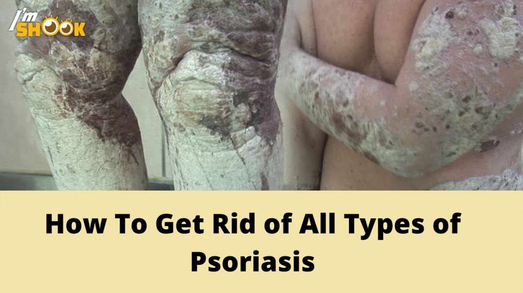 Eliminate all Psoriasis types