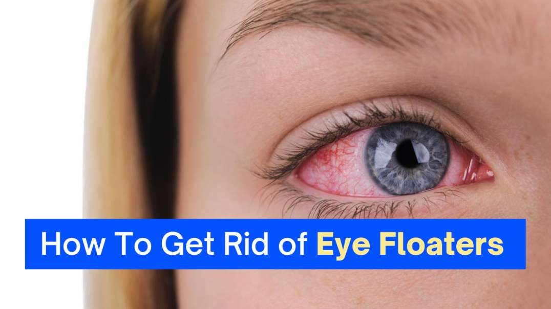 How to Cure Eye Floaters