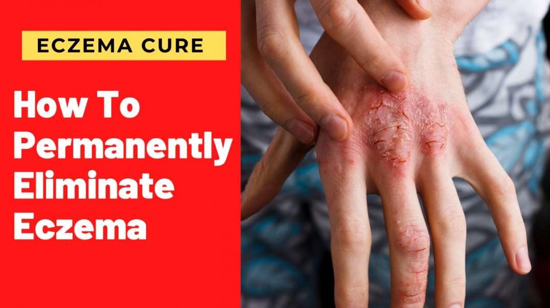 How To Permanently Eliminate Eczema