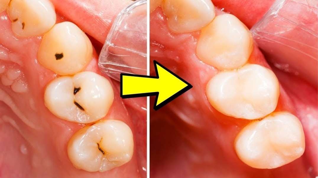 How To Stop Teeth Cavity and Bleeding Gums