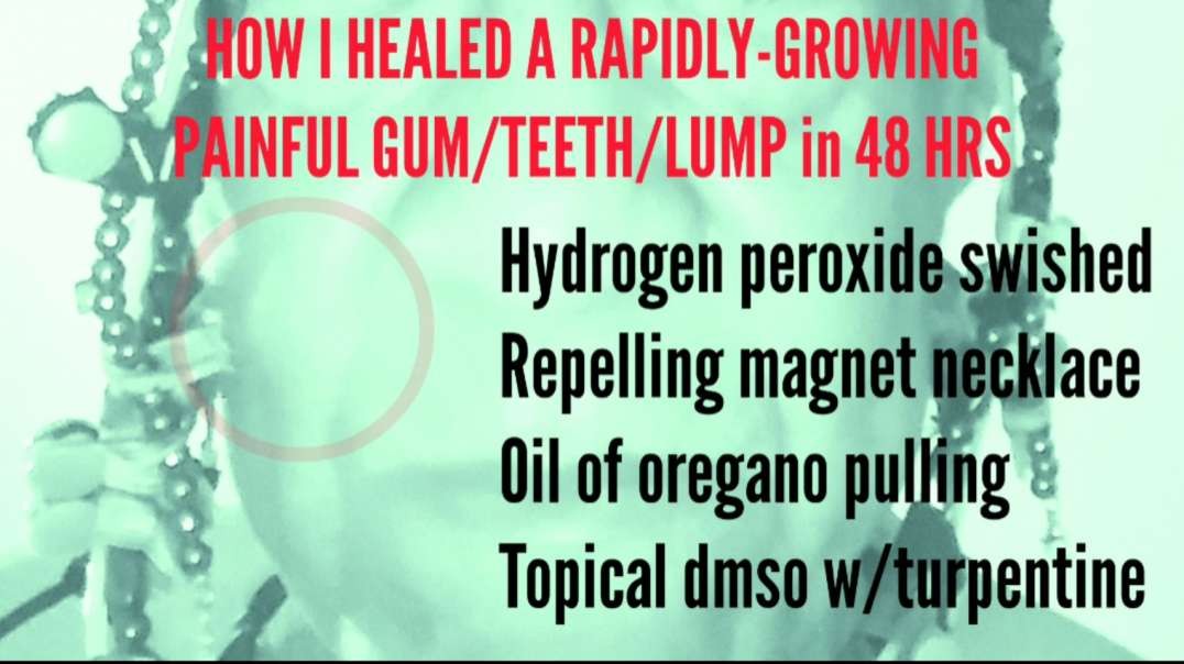 ANTIDOTE:  HOW I HEALED A RAPIDLY-GROWING PAINFUL GUM/TEETH/LUMP in 48 HRS