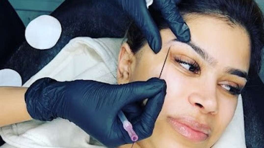 Get The Best Fillers in St Ann's.