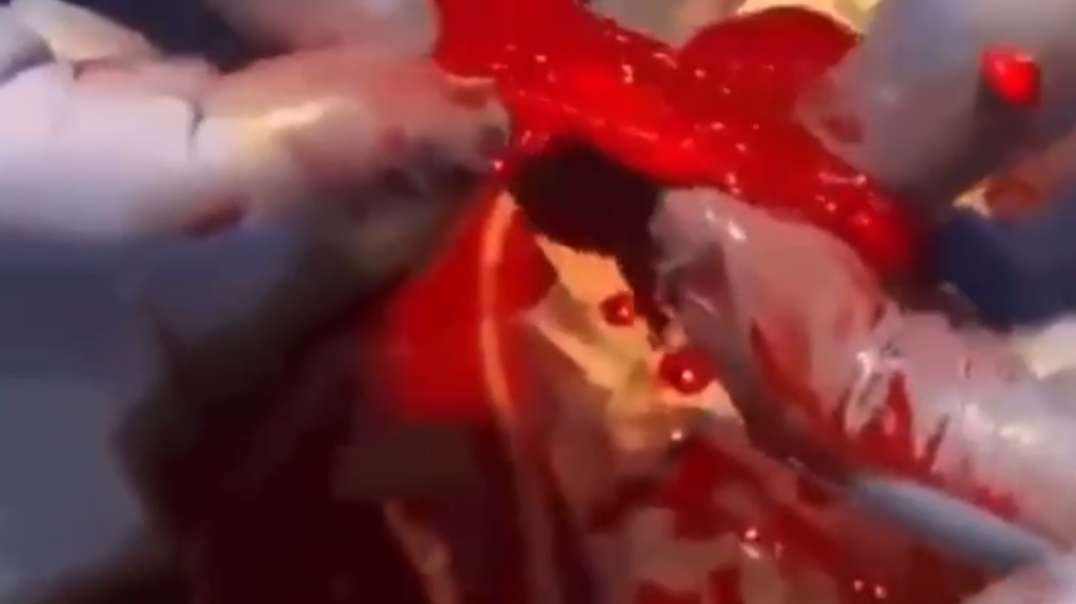 BREAKING — Heart Surgeon Discovers Blood Clots In A Fully Vaccinated 40-Year-Old Athlete