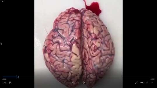 Blood Clots Found Inside a Vaccinated Persons Brain
