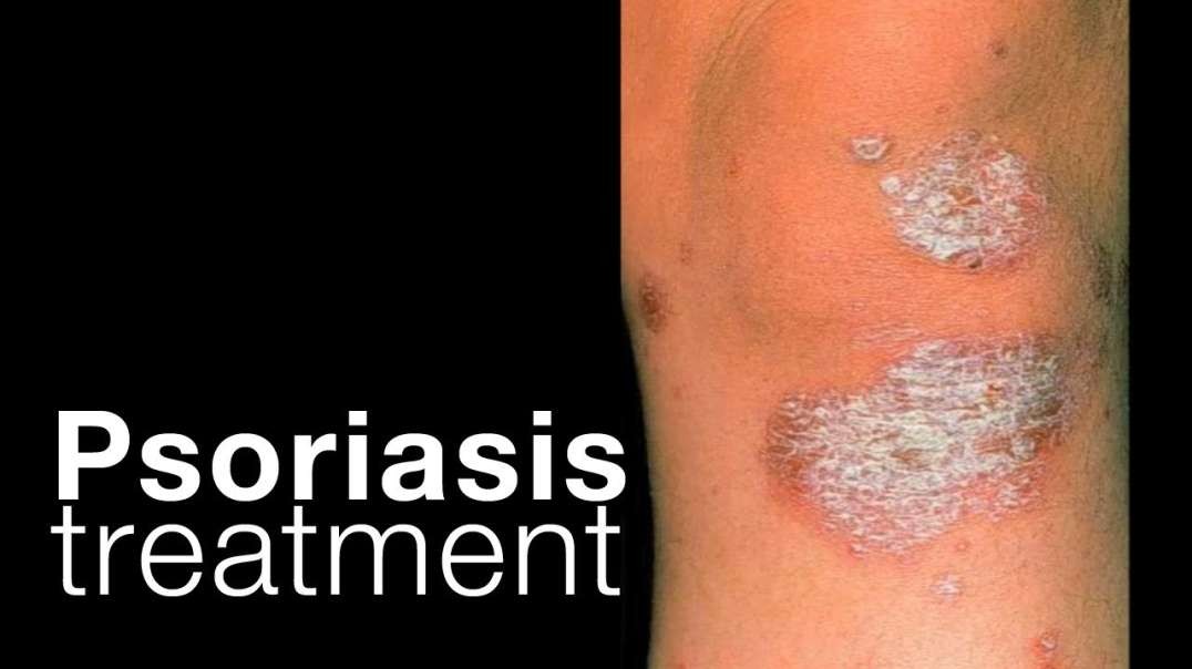 How To Get rid of all types of Psoriasis