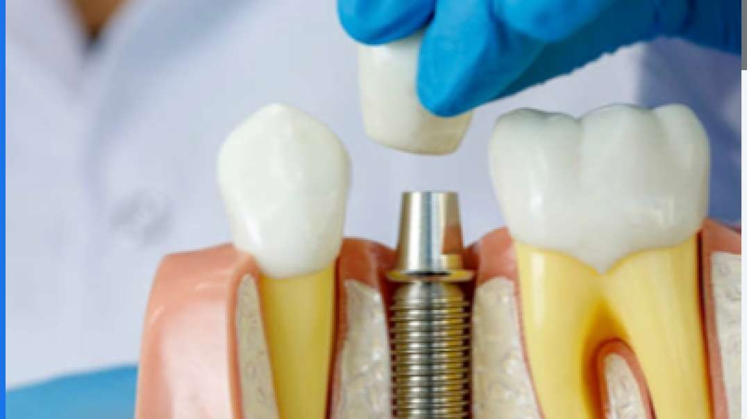 Get the Best Root Canal Emergency in Vaughn