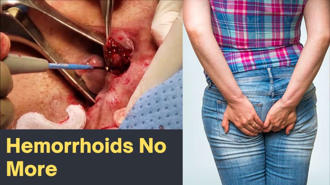 Hemorrhoids | Piles | How To Get Rid Of Hemorrhoids