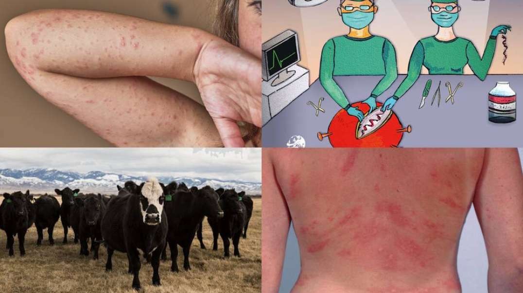 Bombshell! COVID Vaccines Contain Cow Protein That Triggers Deadly Meat Allergies