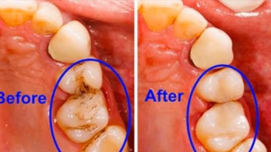 Doctor : That's How To Eliminate Cavities ( Teeth Decay )!!!
