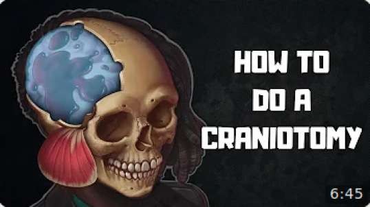 How to Do a Craniotomy (Future Brainchip Removal Difficulties)