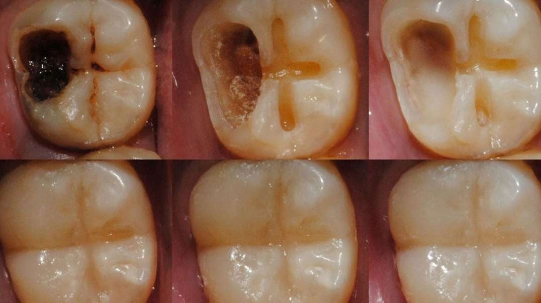 Stop Cavities ( Teeth Decay ) and Bleeding Gums
