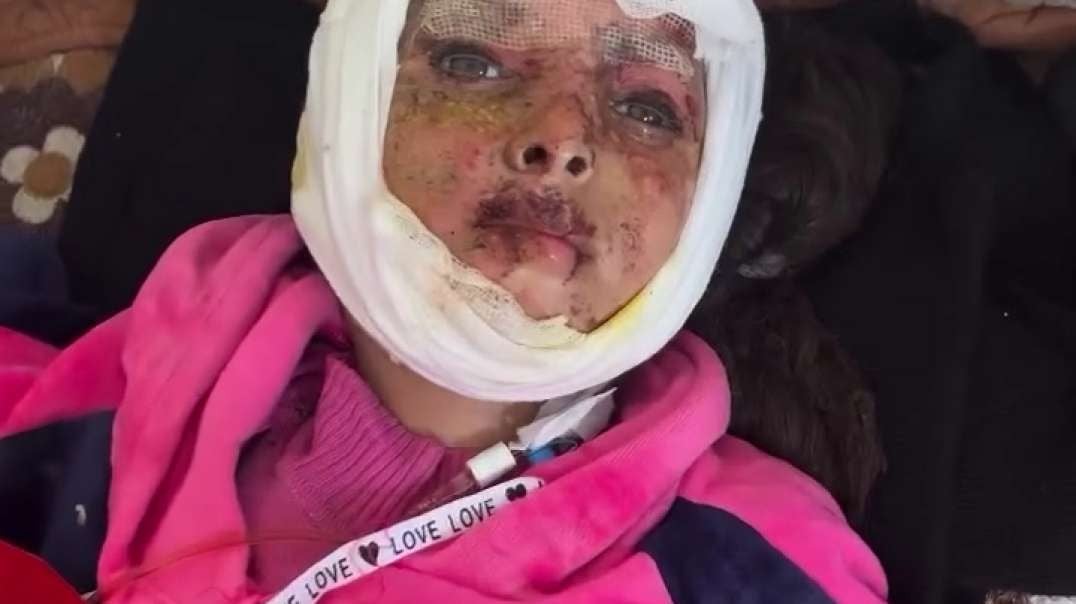 Lone surviving child in Gaza suffering from burns