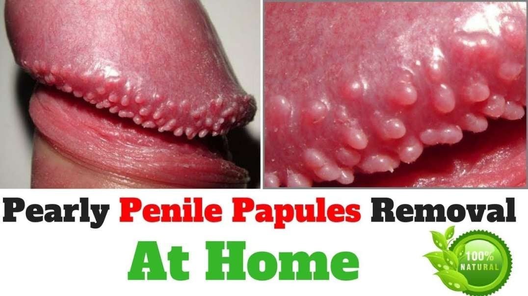 How to Safely Remove Pearly Penile Papules