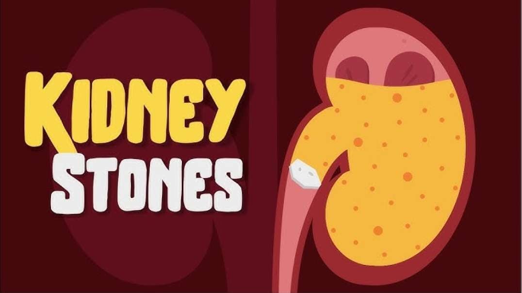 How to Naturally Cure Kidney Stones without Medication