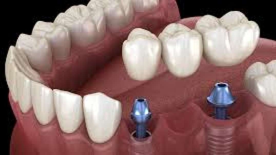 Best Dental Implants in Weston