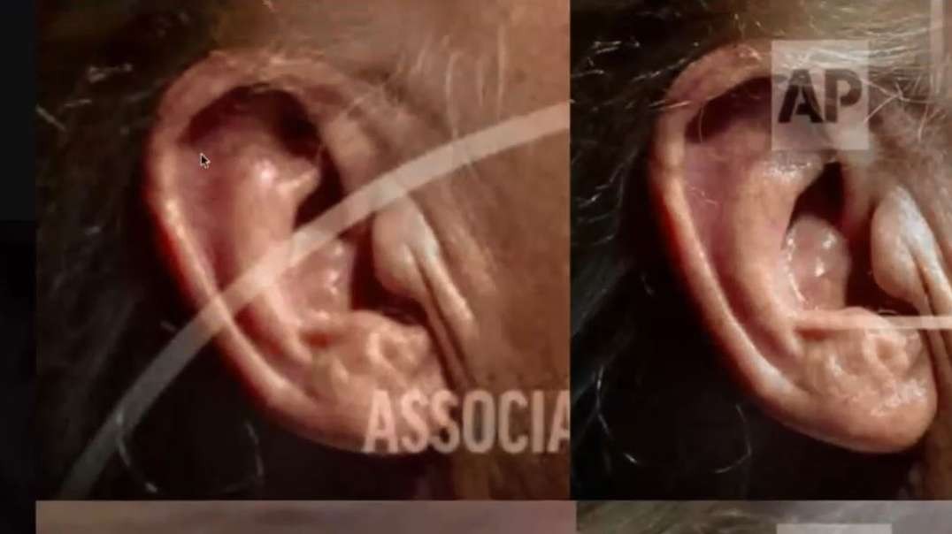 Trumps Ear Anomaly thelastamericanvagabond.mp4