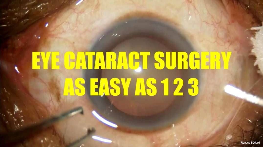 EYE CATARACT SURGERY AS EASY AS 1 2 3