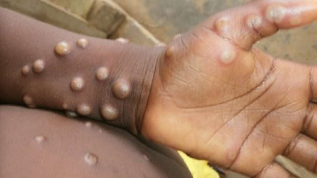 NWO: Dr. Martin says that there is NO monkeypox epidemic!