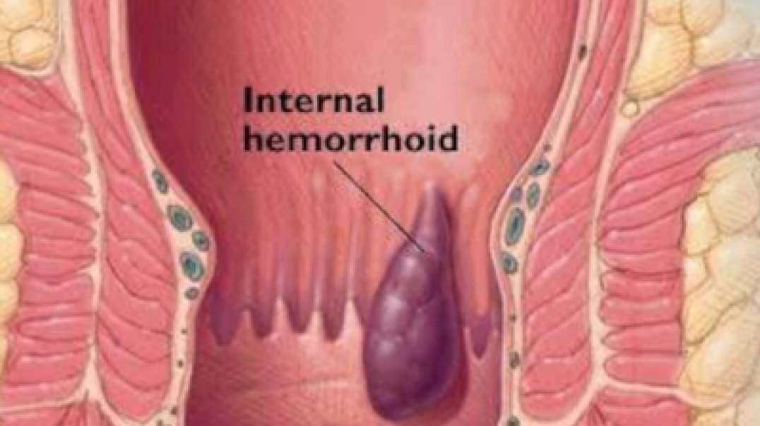 Best Hemorrhoids Surgeon in Ahmedabad