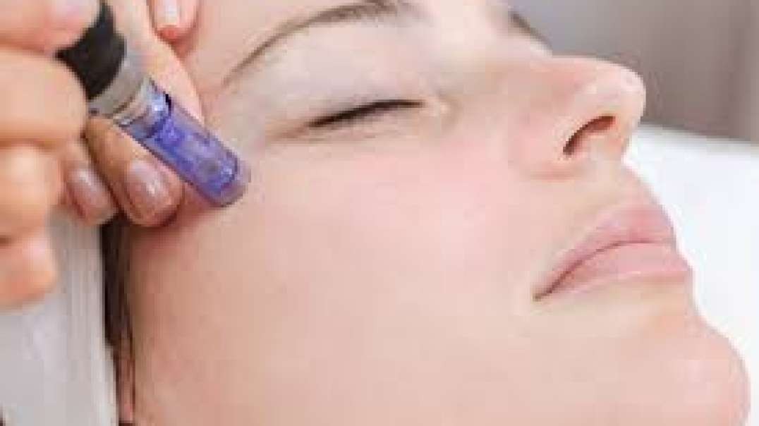 Are you looking for Microneedling in Essendon?